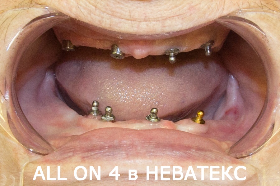 Зубы за 1 день по технологии all - фото промежутоного этапа зубы за 1 день по технологии all фото